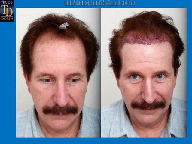 Hair restoration procedure before and after results