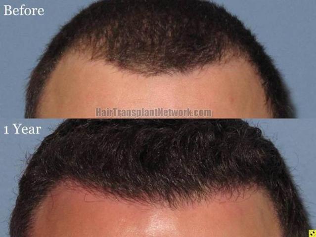 Hair transplant surgery before and after photos