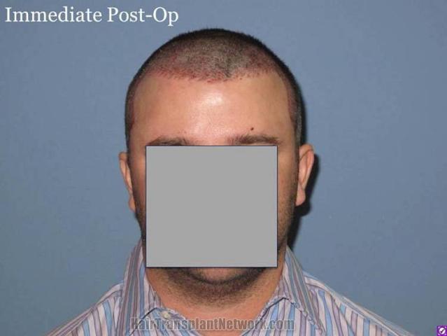 Hair restoration procedure results