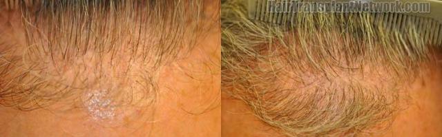 Closeup view of hair restoration procedure hairline