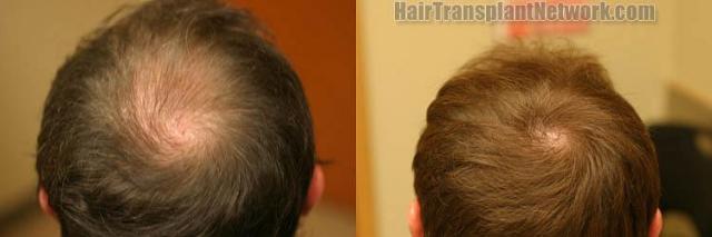 Hair transplantation surgery before and after photos