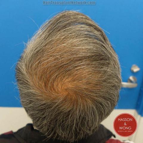 Hair restoration procedure before and after pictures