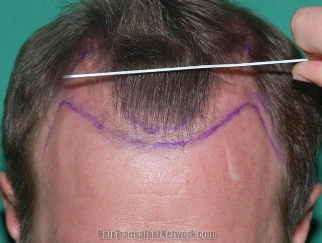 Hair transplantation surgery before and after pictures