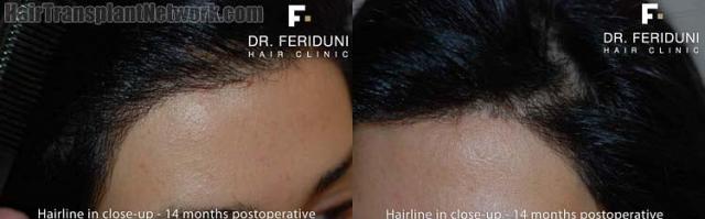 Hair transplant surgery before and after images