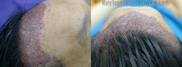 Immediate postoperative hair restoration images