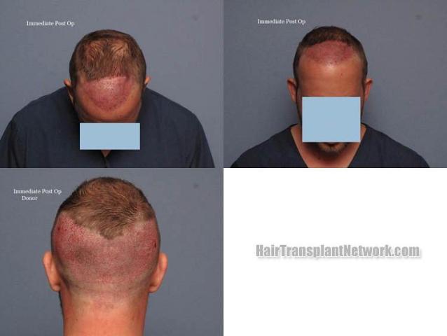 Hair restoration procedure before and after pictures