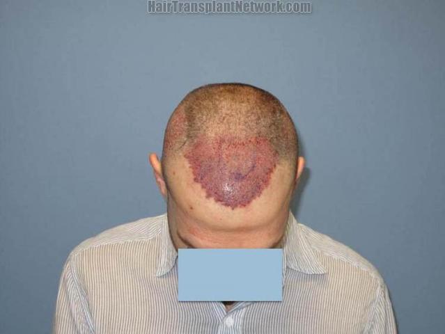 Hair transplantation surgery before and after pictures