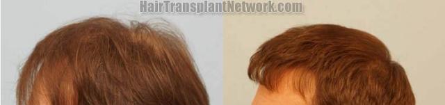 Hair transplantation surgery before and after photos