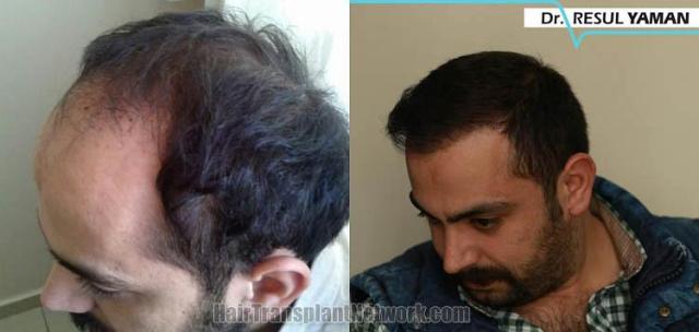 Hair transplantation surgery before and after pictures