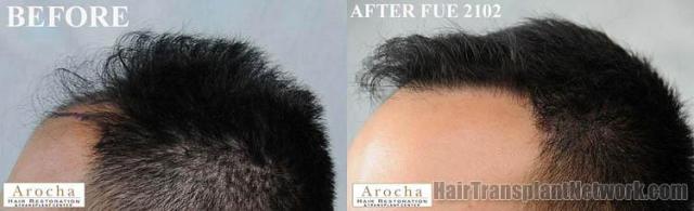 Hair transplantation surgery before and after images