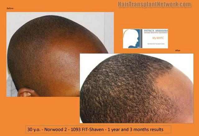 Hair transplantation surgery before and after images