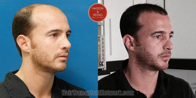 Hair transplantation surgery before and after images