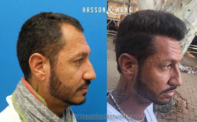 Hair transplantation surgery before and after images