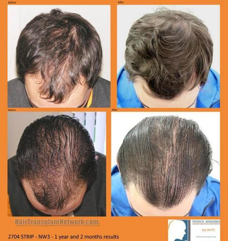 Hair transplantation surgery before and after photos