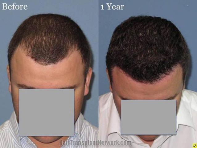 Top view before and after hair restoration results