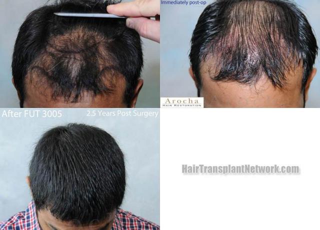 Hair restoration procedure before and after results