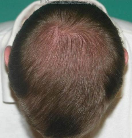 Hair transplant surgery before and after photos