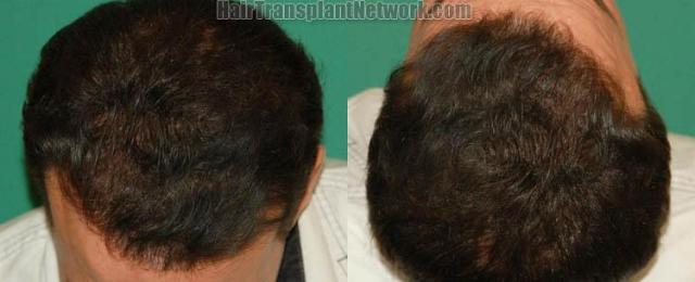 Hair transplantation surgery before and after photos