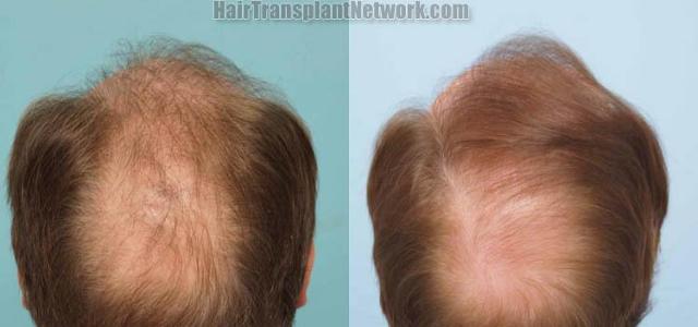 Hair transplantation surgery before and after pictures