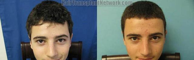 Before and after hair restoration procedure images