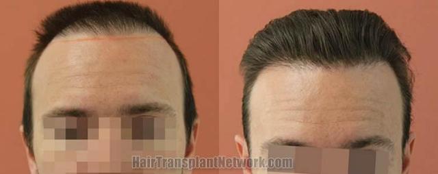 Hair restoration procedure before and after results