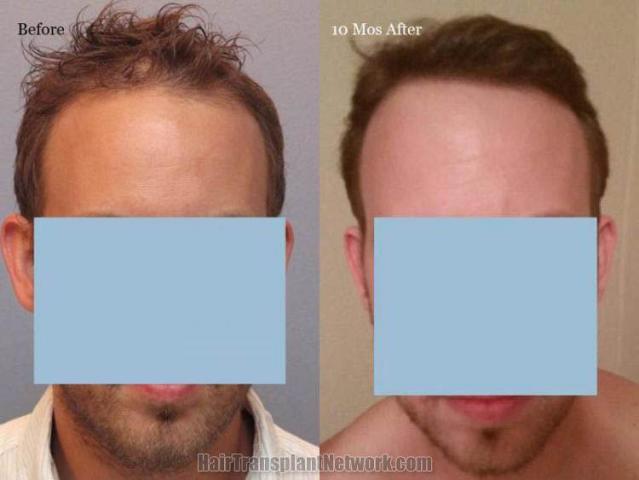 Hair restoration procedure before and after results