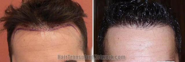 Hair restoration procedure before and after results