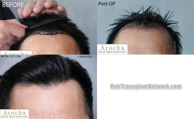 Hair restoration procedure before and after results