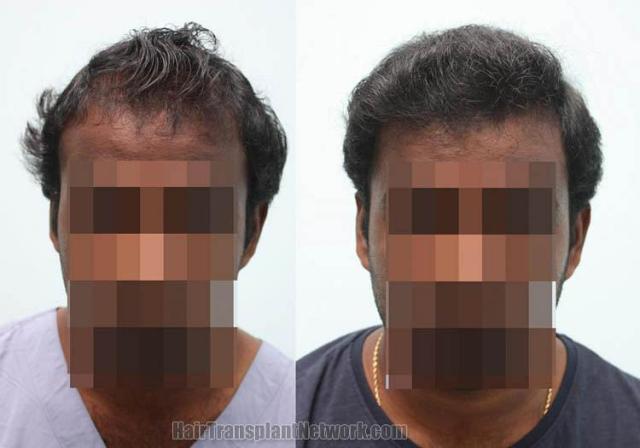 Hair restoration procedure before and after results