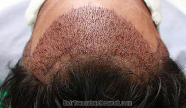 Surgical hair transplantation result photographs