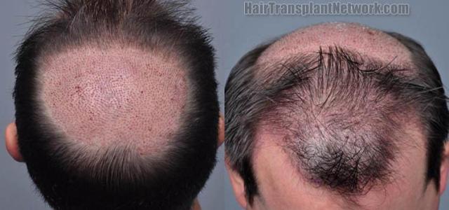 Hair restoration surgery before and after photos