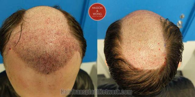 Hair restoration procedure before and after pictures