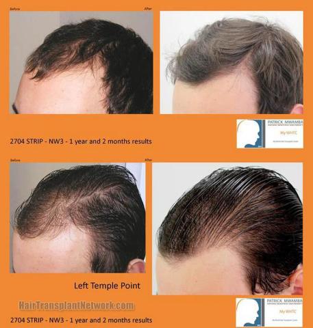 Hair transplantation surgery before and after pictures