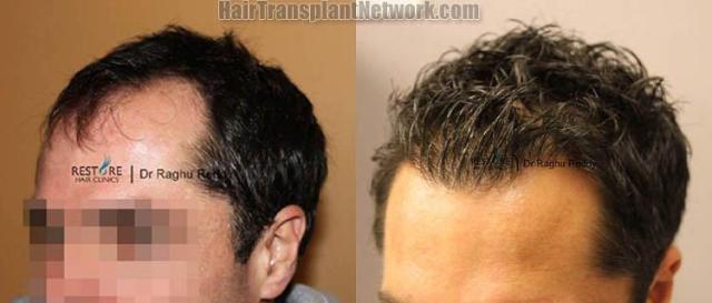 Hair transplantation surgery before and after pictures