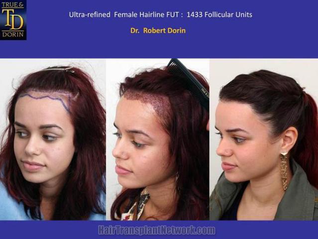 Hair transplantation surgery before and after pictures