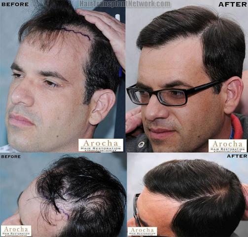 Hair transplantation surgery before and after images