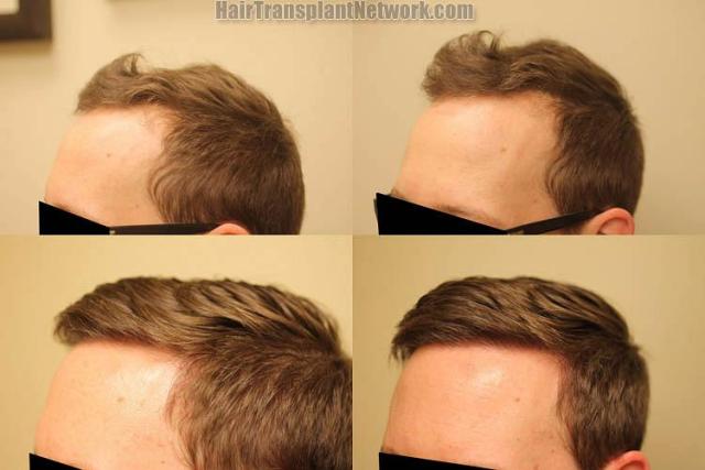 Hair restoration procedure before and after results