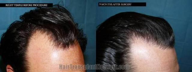 Before and after hair transplant procedure images