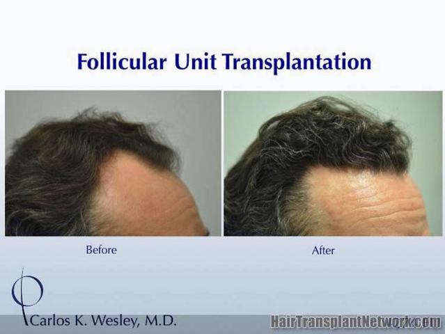 Hair restoration procedure before and after results