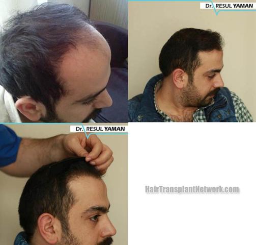 Hair transplantation surgery before and after images