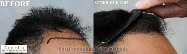 Hair transplantation surgery before and after photos