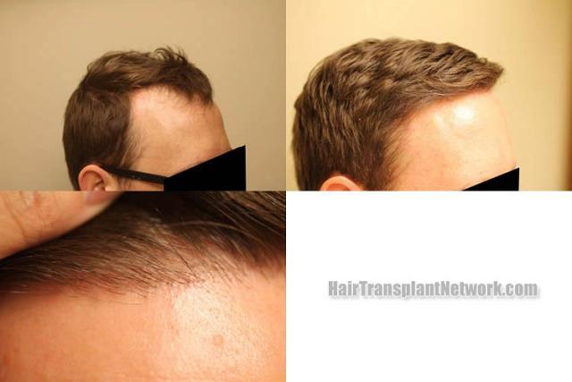 Hair transplantation surgery before and after images