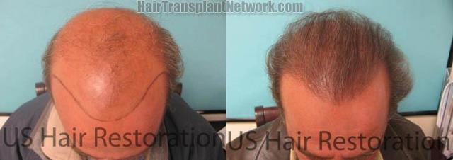 Hair restoration surgery before and after photos