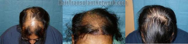 Top view - Before and after hair restoration procedure