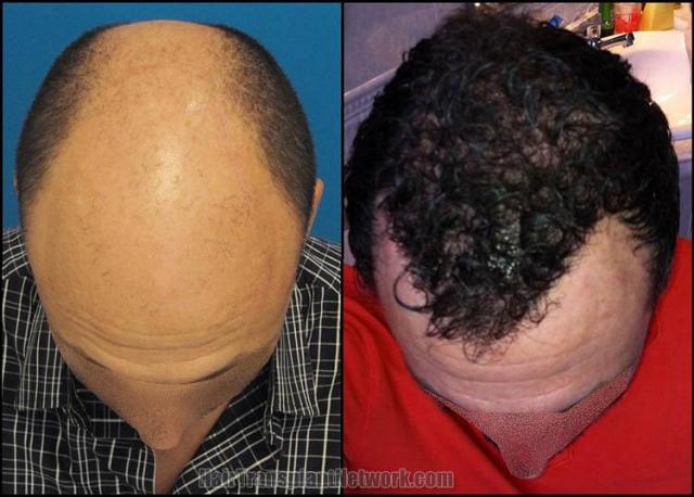 Before and after hair transplant procedure images