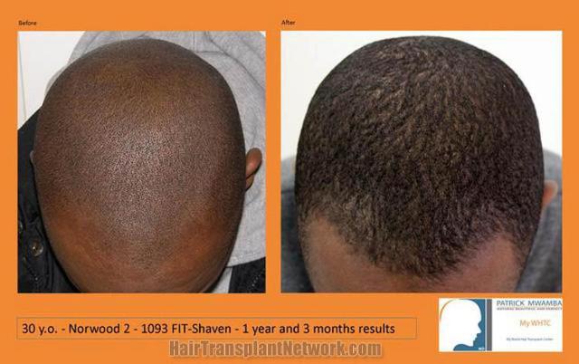 Hair transplantation surgery before and after photos