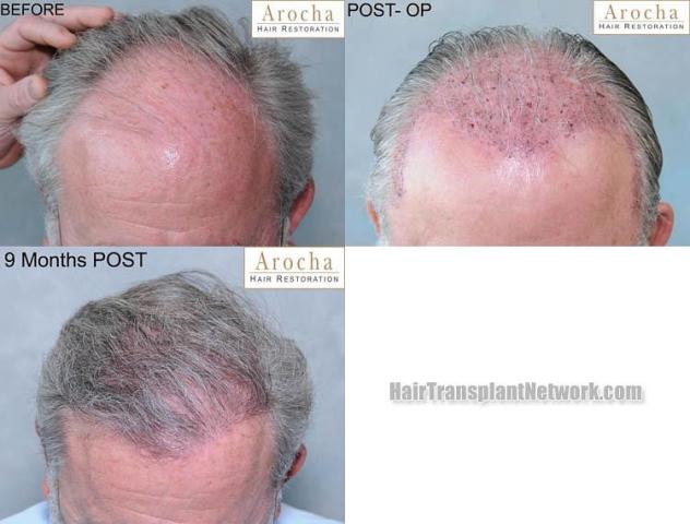 Hair restoration procedure before and after pictures