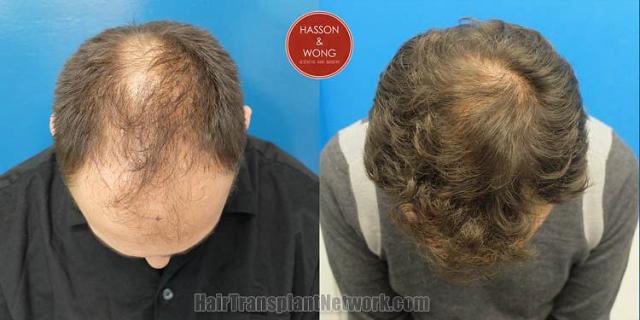 Hair transplantation surgery before and after pictures