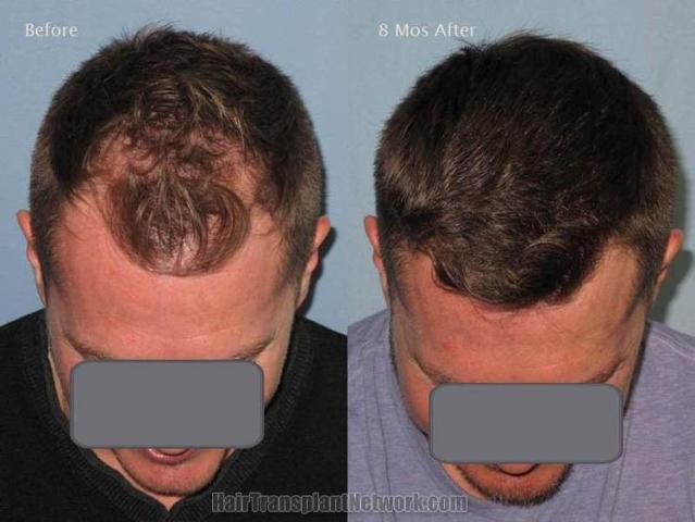 Top view before and after hair restoration results