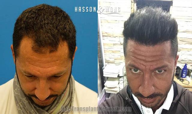 Hair transplantation surgery before and after photos